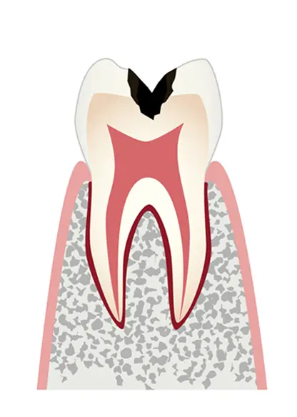 虫歯がエナメル質の内側にある「象牙質」にまで進行した状態のイラスト