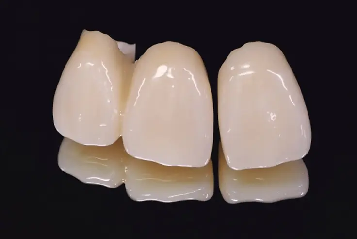 セラミックインレーの模型