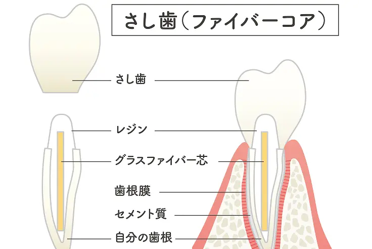 グラスファイバー製のポスト（柱）を差し込んだイラスト