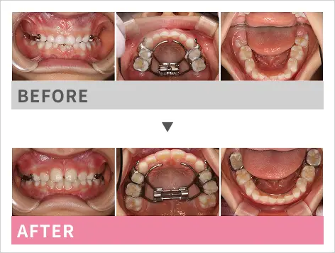 小児矯正歯科ケース２の口腔内比較画像