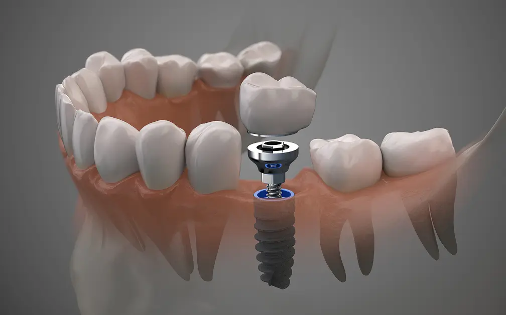 インプラントを歯に埋め込む様子